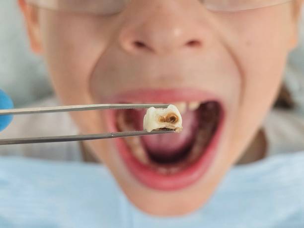 Best Emergency Tooth Extraction in Waterflow, NM